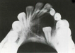 Dentoalveolárna a maxilofaciálna chirurgia IV