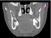 Benígne kostné lézie neodontogénneho pôvodu v maxilofaciálnej oblasti