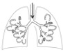 Syndróm akútnej respiračnej tiesne (ARDS) – od etiopatogenézy k liečbe