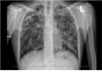Tuberkulóza pľúc