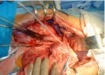 Základy pre odber orgánov a transplantáciu obličky