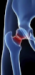 Zlomeniny horného konca stehnovej kosti – diagnostika, liečba a komplikácie